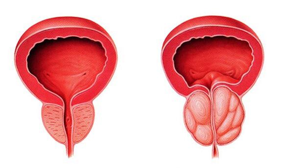 Normalna in vneta prostata (prostatitis)