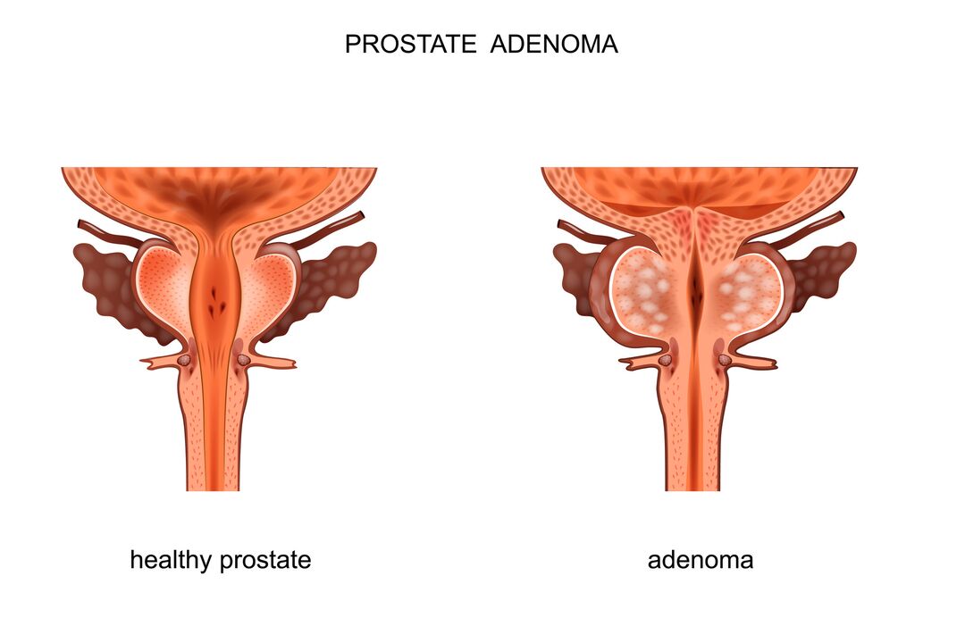 Zdrava prostata in adenom