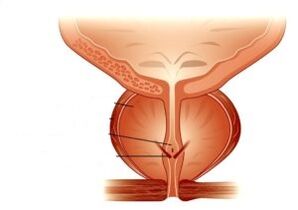 prostatitis in njegovo zdravljenje z zdravili