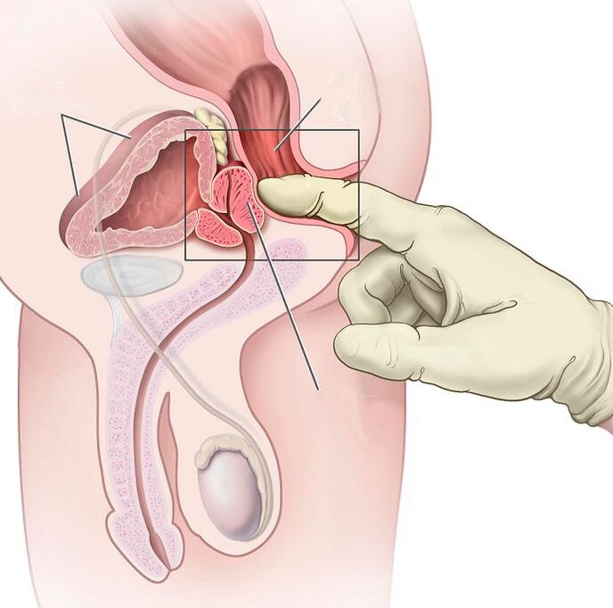 Masaža prostate za zdravljenje prostatitisa