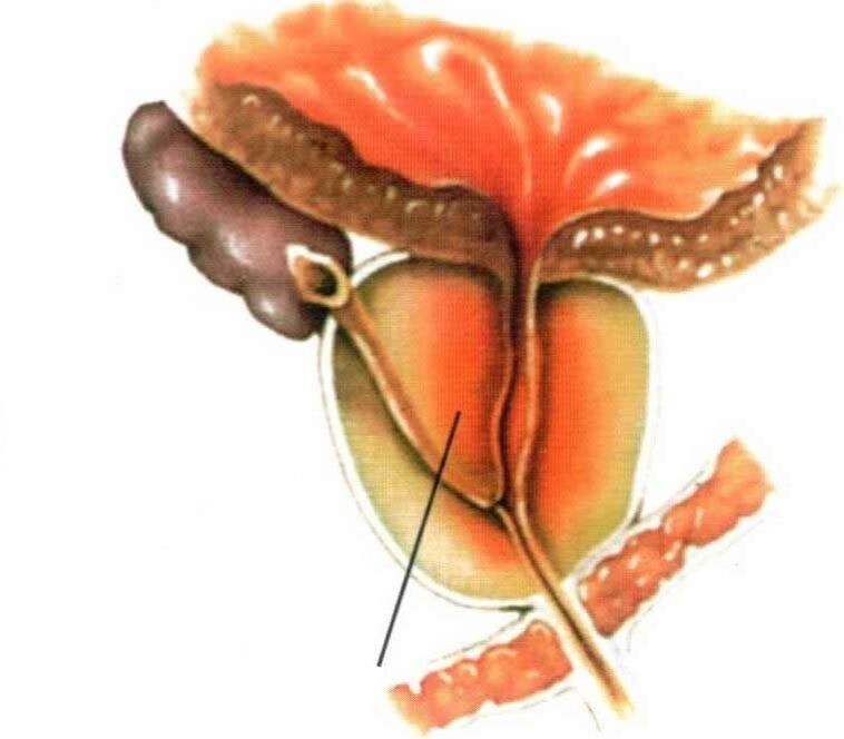 Vnetje tkiva prostate pri kroničnem prostatitisu